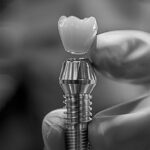 Implantes Dentales vs. Prótesis Dental: ¿Cuál es la Diferencia?